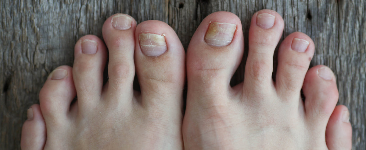 what is morton's toe